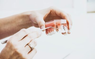 Ile trwa wszczepienie implantu zęba? Założenie implantów krok po kroku