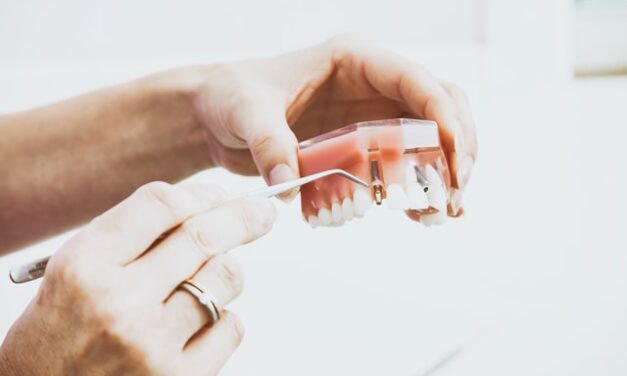 Ile trwa wszczepienie implantu zęba? Założenie implantów krok po kroku